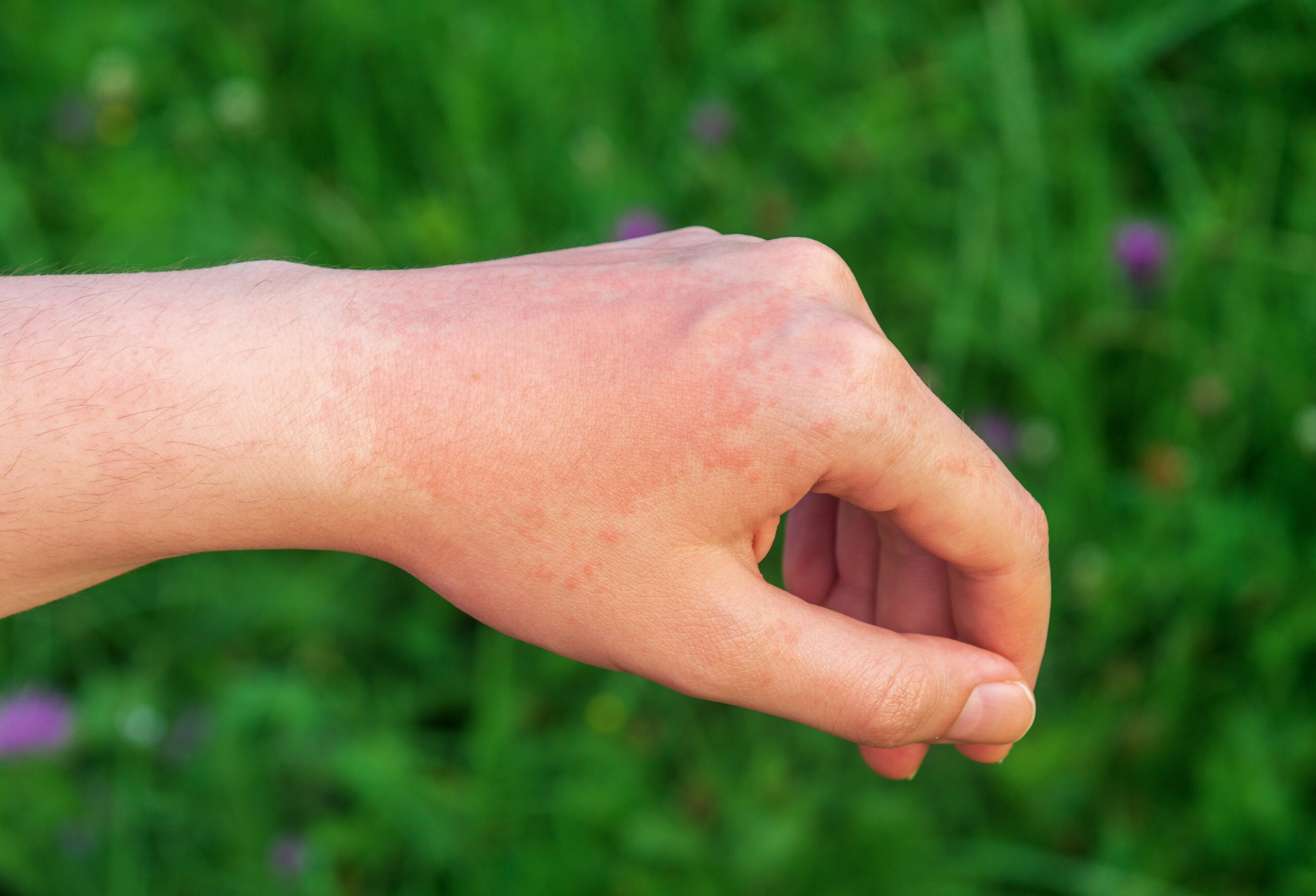 аллергия на теле фото с пояснениями